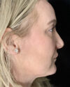 Blepharoplasty case #4849