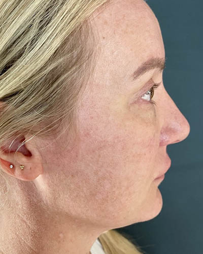 Blepharoplasty case #4849