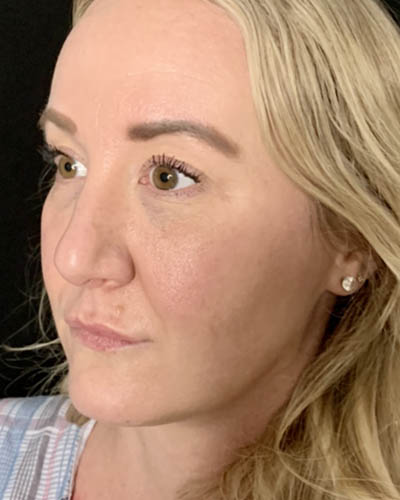 Blepharoplasty case #4849