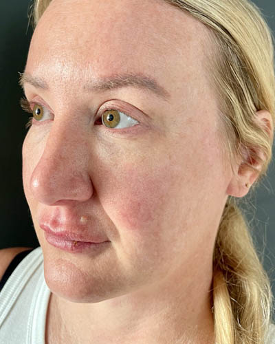 Blepharoplasty case #4849