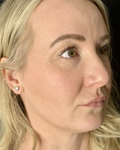 Blepharoplasty case #4849
