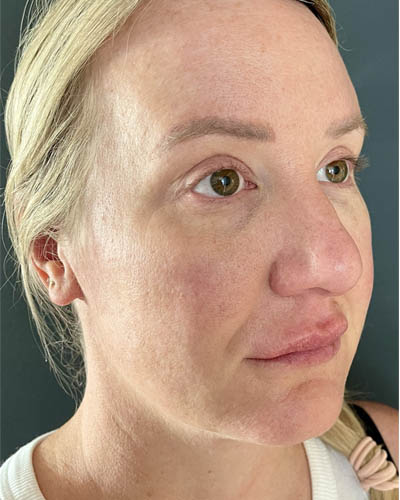 Blepharoplasty case #4849