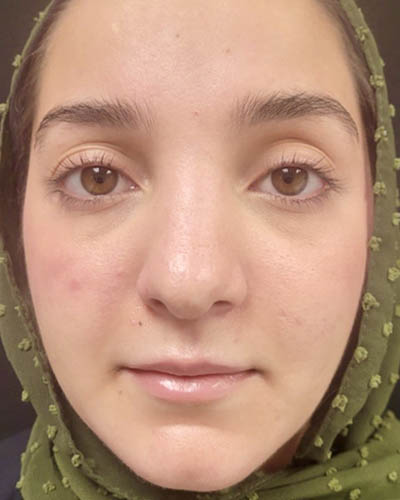 Rhinoplasty case #4907