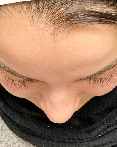 Rhinoplasty case #4907