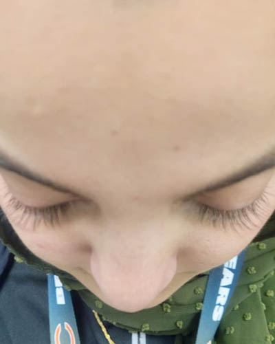 Rhinoplasty case #4907