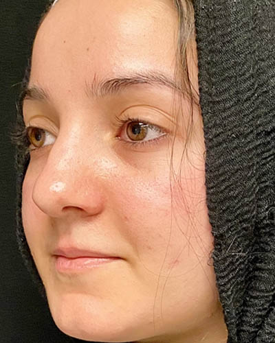 Rhinoplasty case #4907