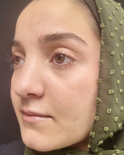 Rhinoplasty case #4907