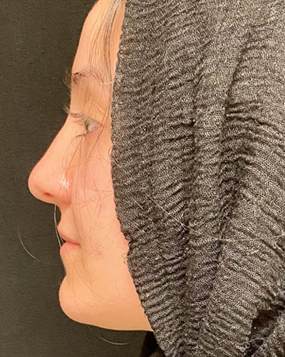 Rhinoplasty case #4907