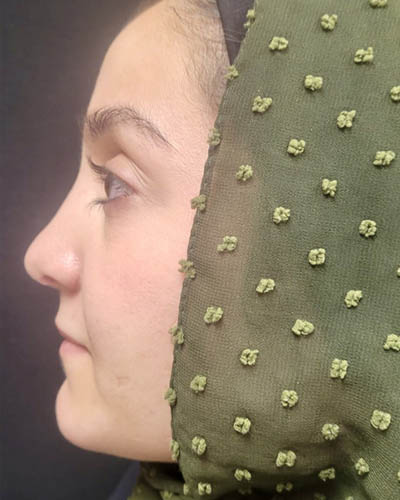 Rhinoplasty case #4907