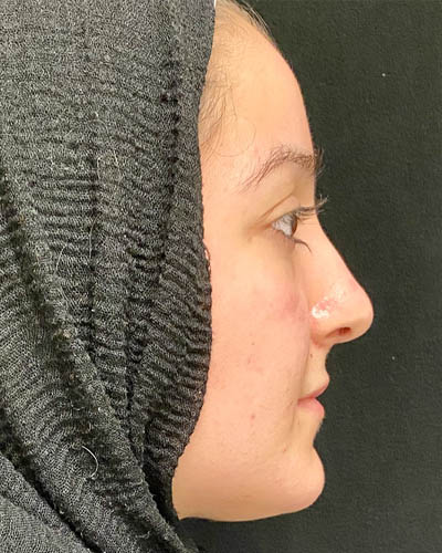 Rhinoplasty case #4907