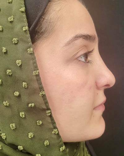 Rhinoplasty case #4907