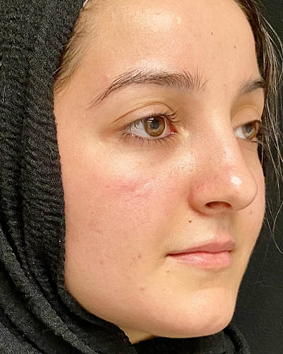 Rhinoplasty case #4907