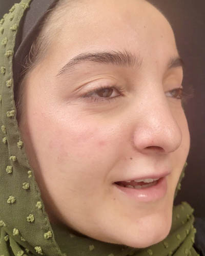 Rhinoplasty case #4907