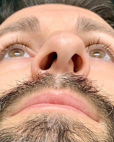 Rhinoplasty case #4922