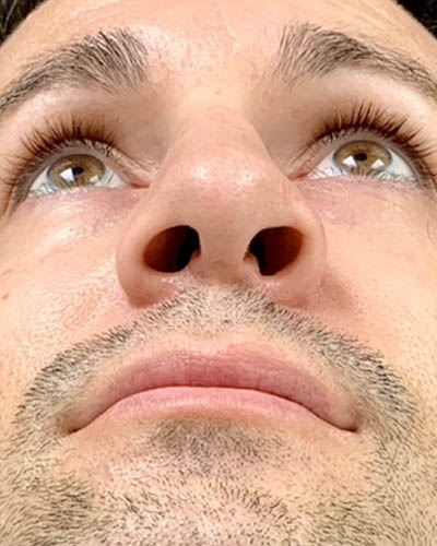 Rhinoplasty case #4922