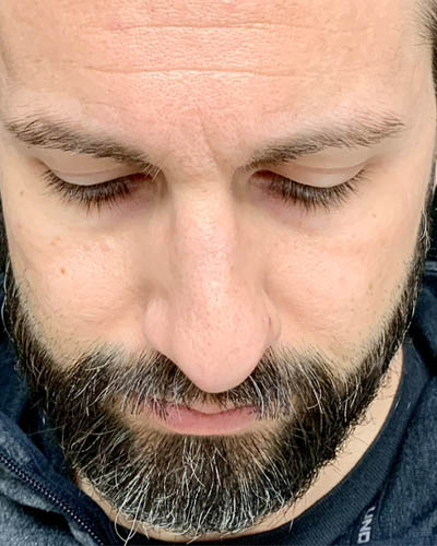 Rhinoplasty case #4922