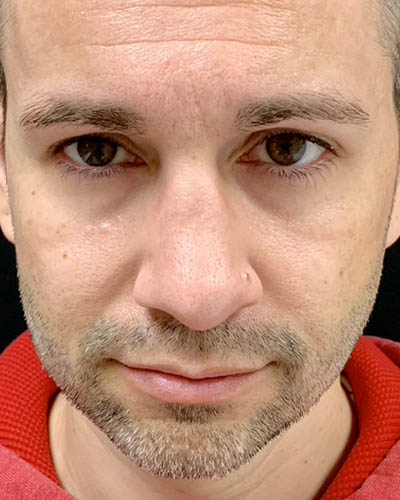 Rhinoplasty case #4922