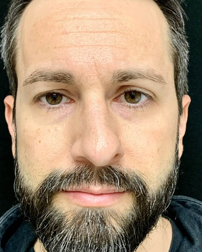 Rhinoplasty case #4922