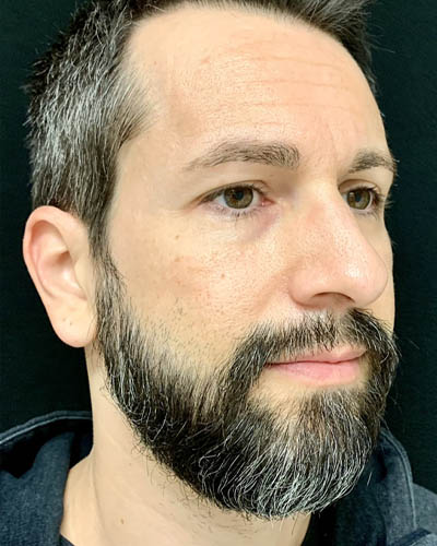 Rhinoplasty case #4922