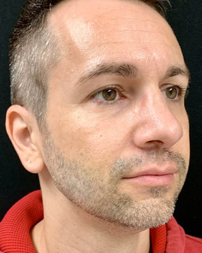 Rhinoplasty case #4922