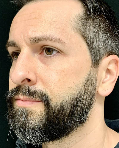 Rhinoplasty case #4922