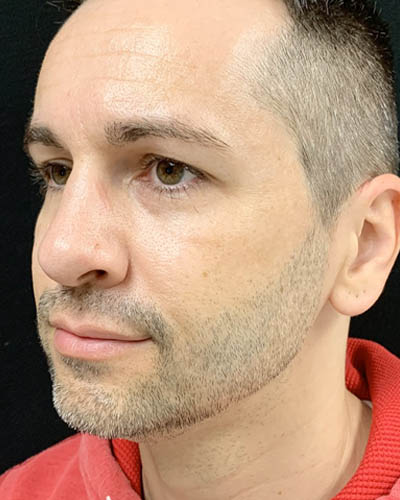 Rhinoplasty case #4922