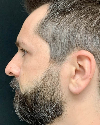 Rhinoplasty case #4922