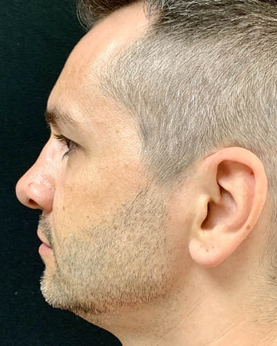 Rhinoplasty case #4922
