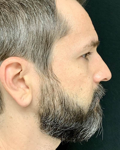 Rhinoplasty case #4922