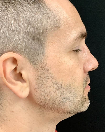 Rhinoplasty case #4922