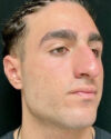 Rhinoplasty case #4937