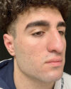 Rhinoplasty case #4937