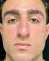 Rhinoplasty case #4937