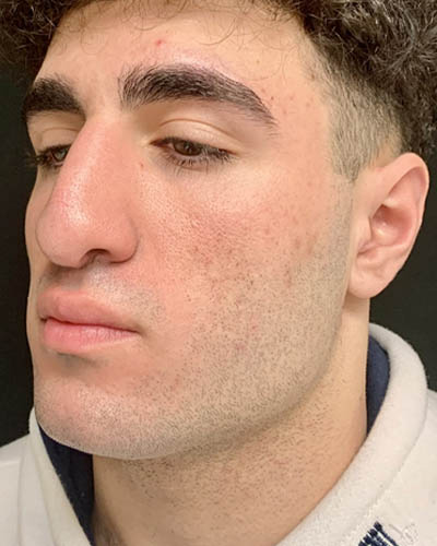 Rhinoplasty case #4937