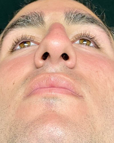 Rhinoplasty case #4937