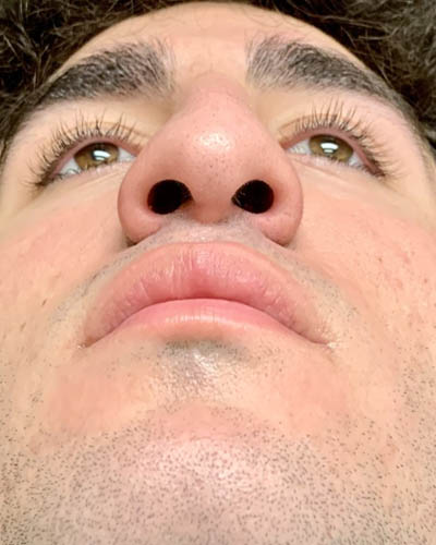 Rhinoplasty case #4937