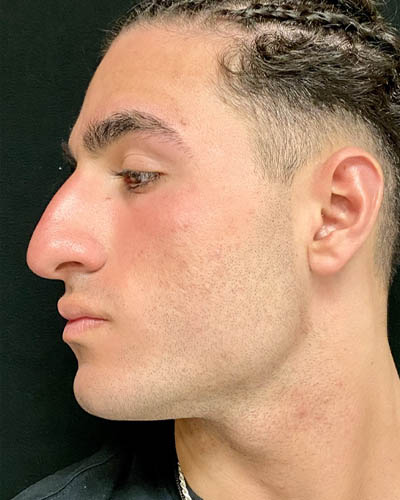 Rhinoplasty case #4937