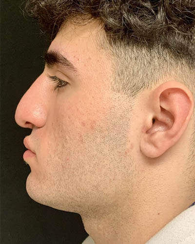 Rhinoplasty case #4937