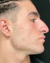 Rhinoplasty case #4937