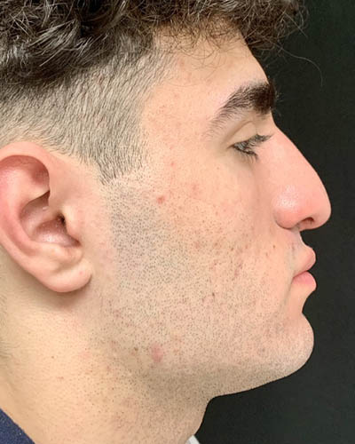 Rhinoplasty case #4937