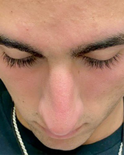 Rhinoplasty case #4937