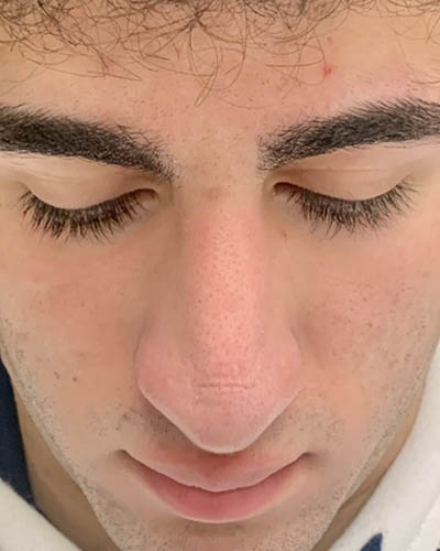 Rhinoplasty case #4937