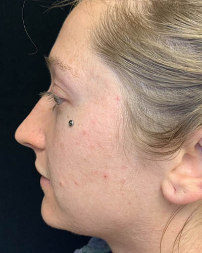Rhinoplasty case #4952