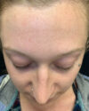 Rhinoplasty case #4952