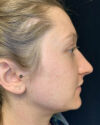 Rhinoplasty case #4952