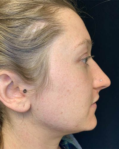 Rhinoplasty case #4952