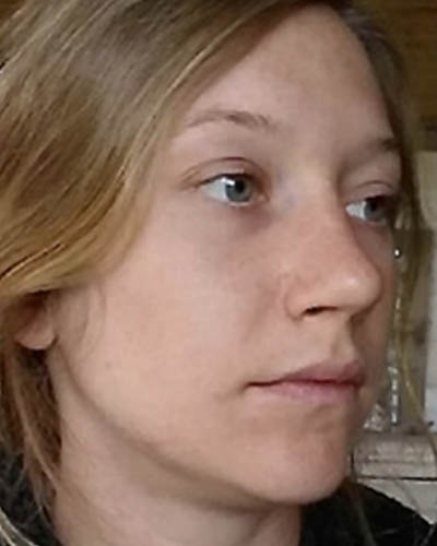 Rhinoplasty case #4952