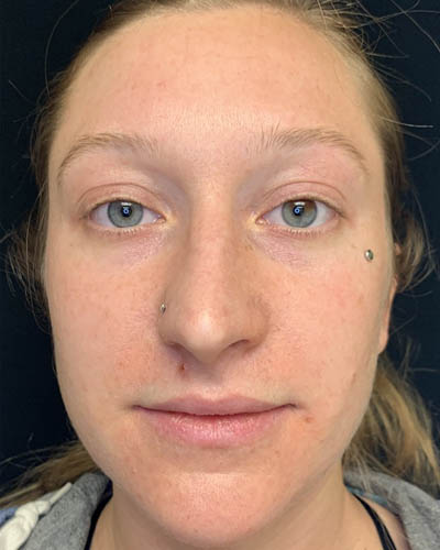 Rhinoplasty case #4952