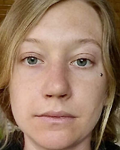 Rhinoplasty case #4952