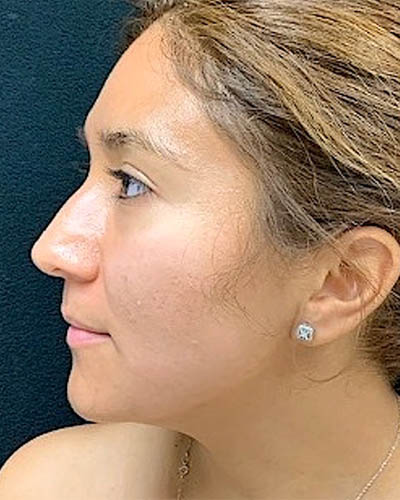 Rhinoplasty case #4965